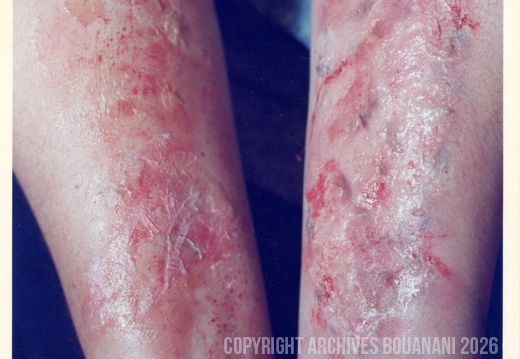 Bras blessures Naima006