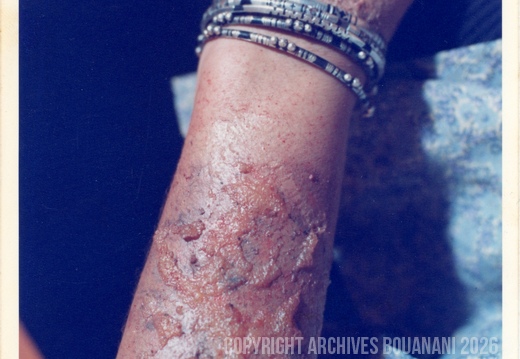 Bras blessures Naima007